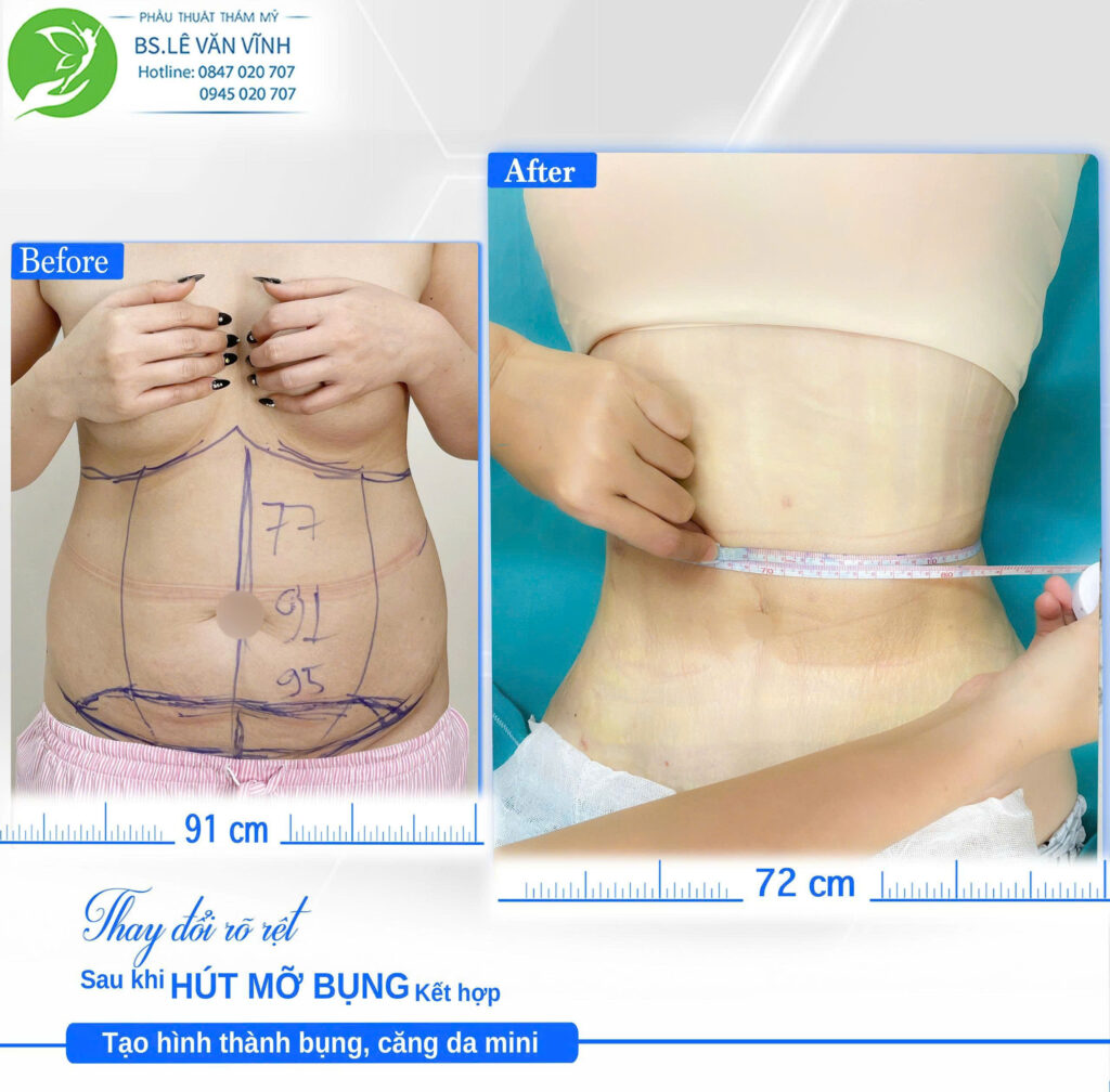 Hút mỡ bụng Bác sĩ Lê Văn Vĩnh