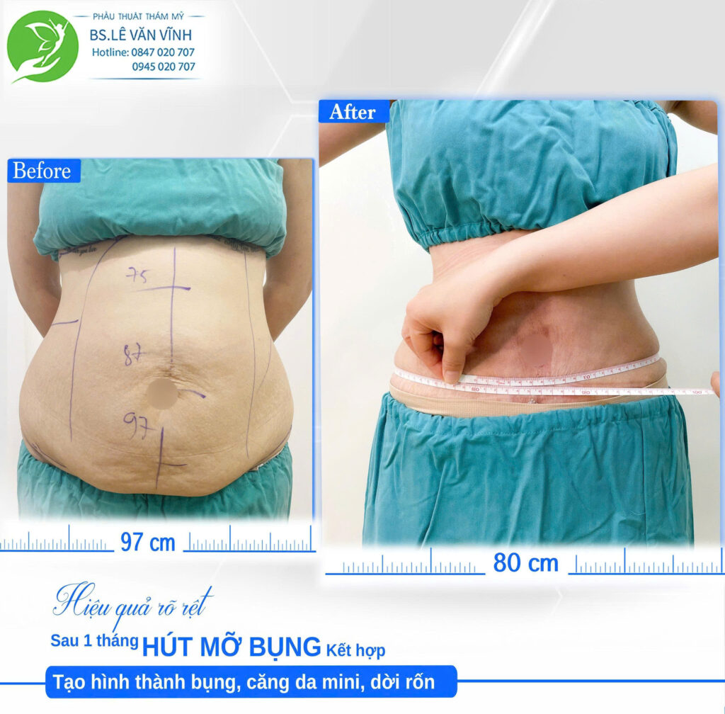 Hút mỡ bụng Bác sĩ Lê Văn Vĩnh