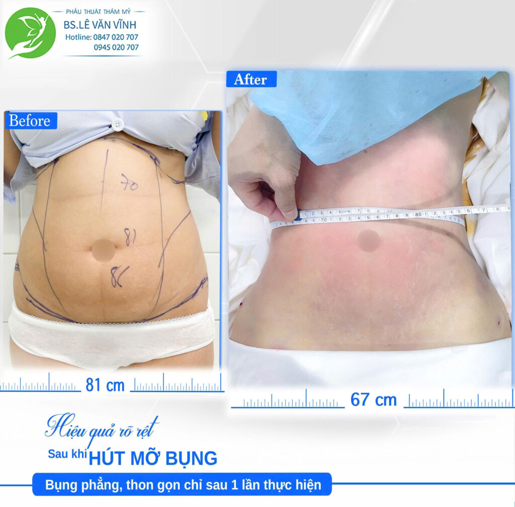 Hút mỡ bụng Bác sĩ Lê Văn Vĩnh