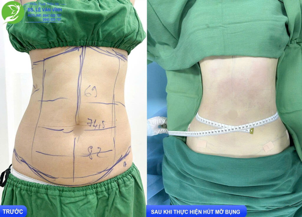 Hút mỡ bụng do Bác sĩ Lê Văn Vĩnh thực hiện