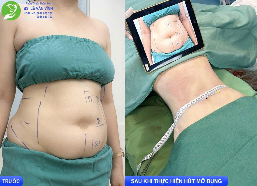 Hút mỡ bụng do Bác sĩ Lê Văn Vĩnh thực hiện
