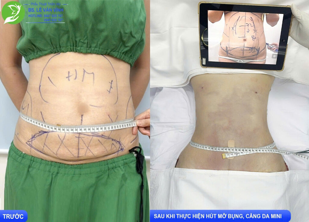 Hút mỡ bụng do Bác sĩ Lê Văn Vĩnh thực hiện