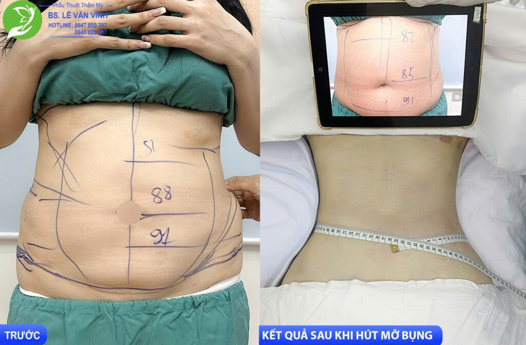 Hút mỡ bụng do Bác sĩ Lê Văn Vĩnh thực hiện