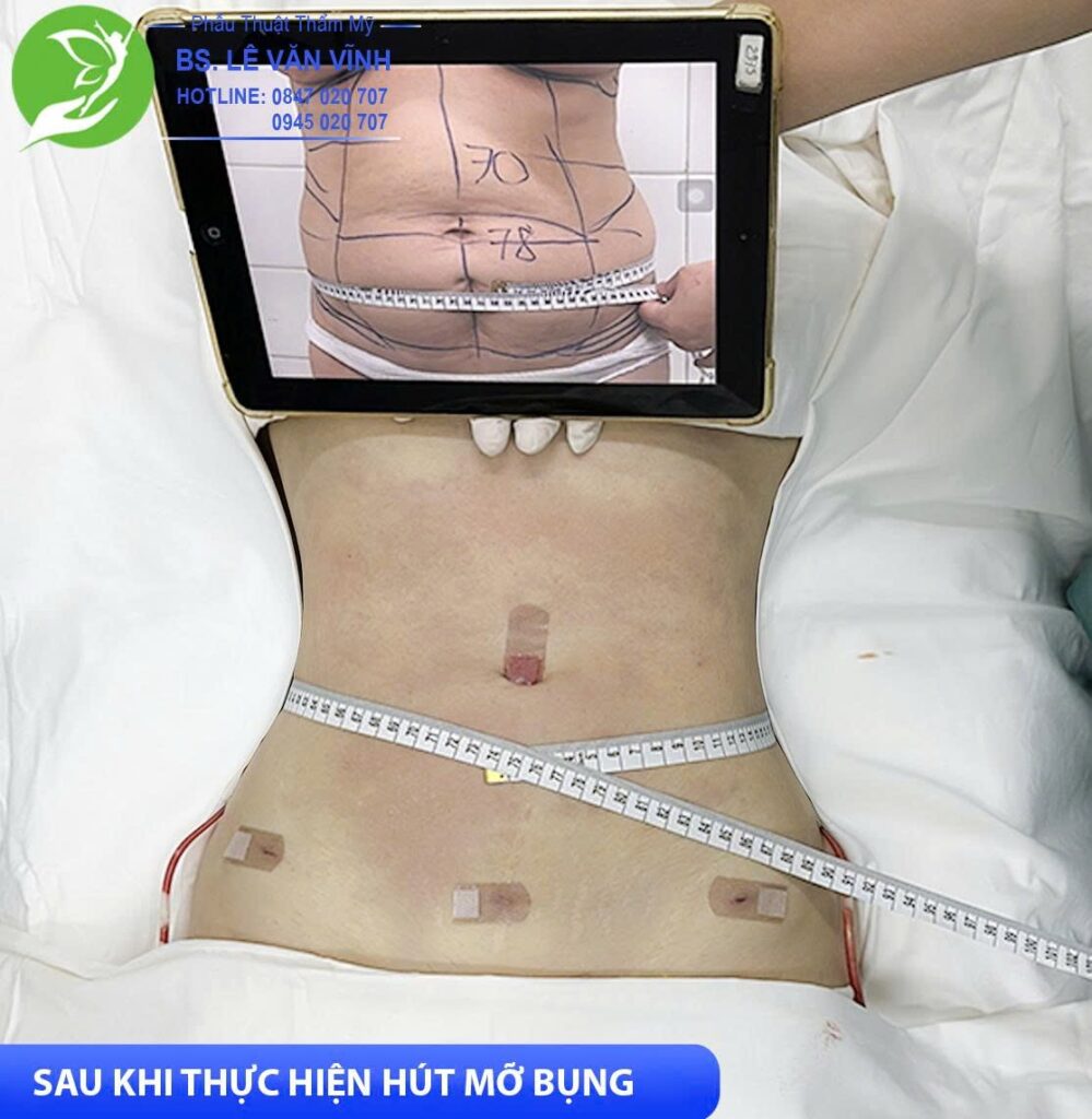 Hút mỡ bụng do Bác sĩ Lê Văn Vĩnh thực hiện