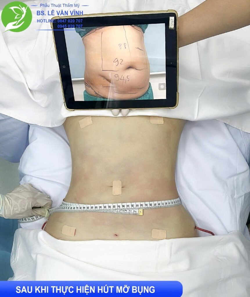 Hút mỡ bụng do Bác sĩ Lê Văn Vĩnh thực hiện