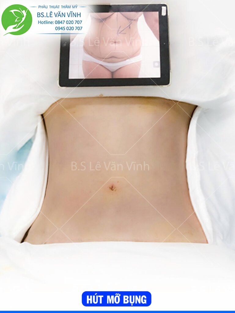 Hút mỡ bụng do Bác sĩ Lê Văn Vĩnh thực hiện