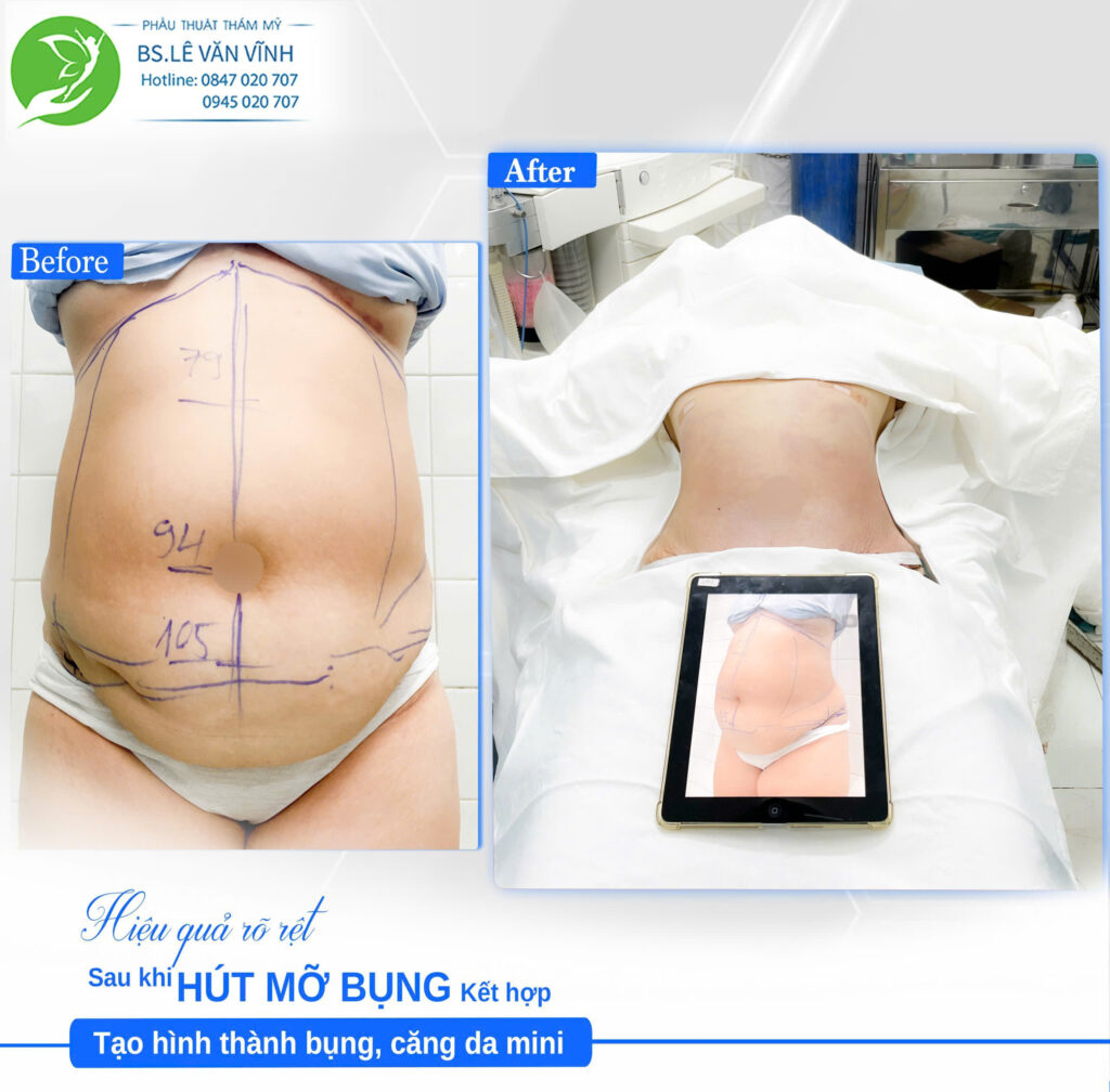 Hút mỡ bụng do Bác sĩ Lê Văn Vĩnh thực hiện