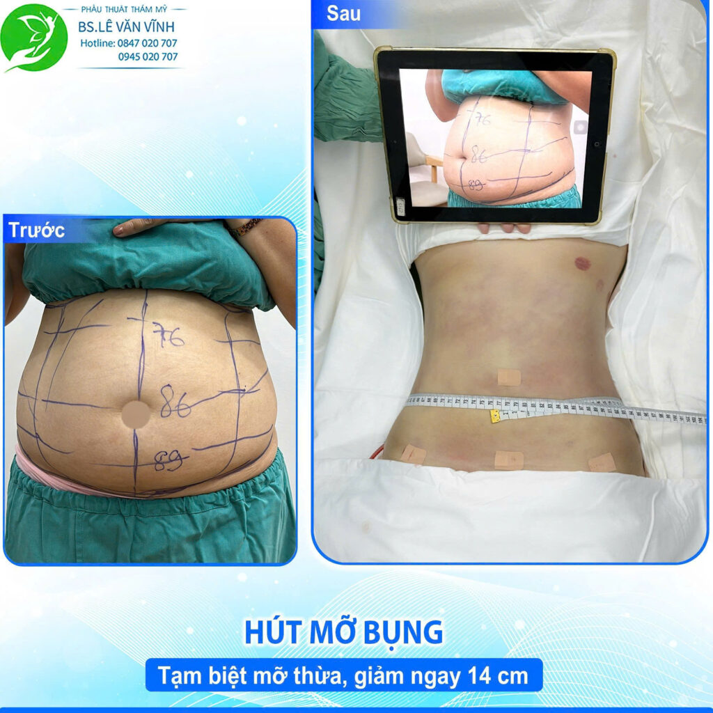 Hút mỡ bụng do Bác sĩ Lê Văn Vĩnh thực hiện
