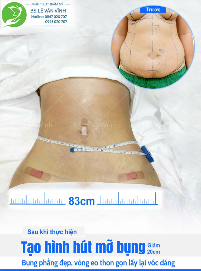 Hút mỡ bụng do Bác sĩ Lê Văn Vĩnh thực hiện