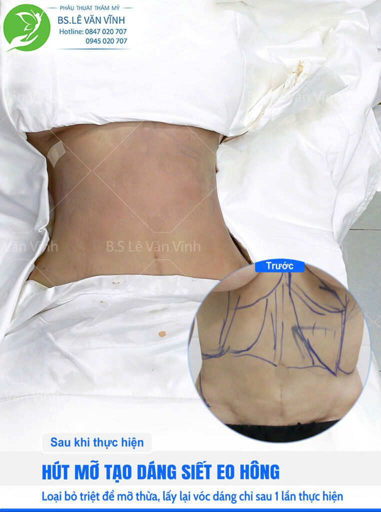 Hút mỡ bụng do Bác sĩ Lê Văn Vĩnh thực hiện