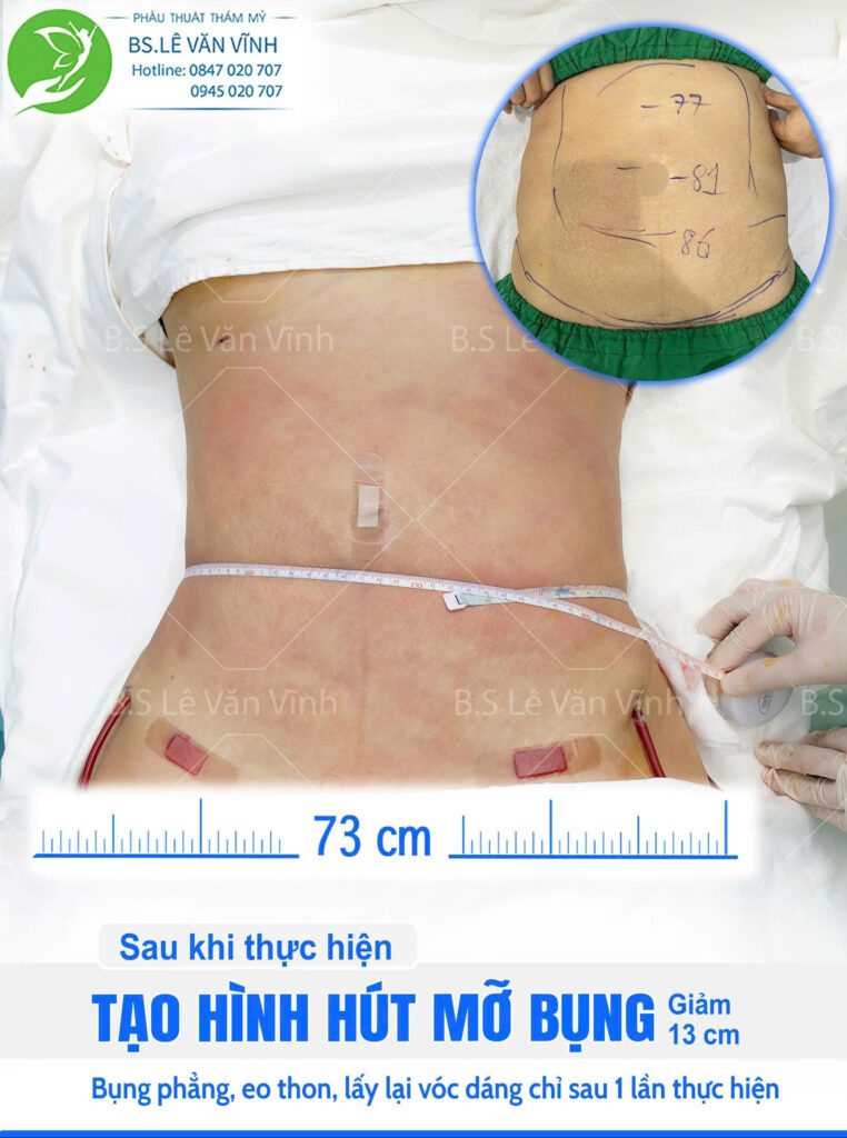 Hút mỡ bụng do Bác sĩ Lê Văn Vĩnh thực hiện