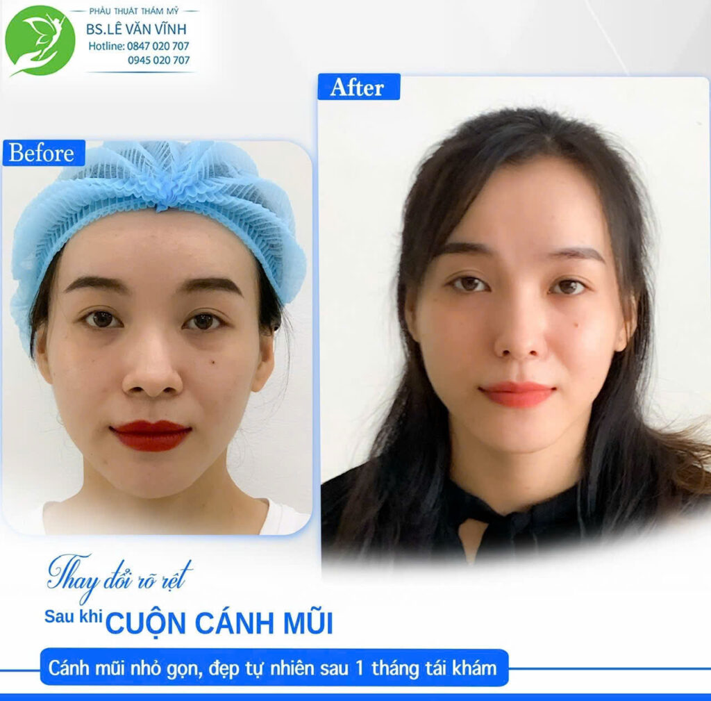 Cuộn cánh mũi do Bác sĩ Lê Văn Vĩnh thực hiện