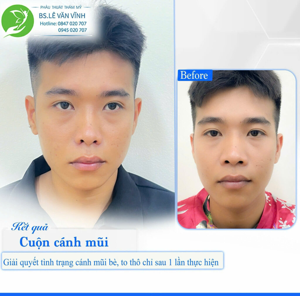 Cuộn cánh mũi do Bác sĩ Lê Văn Vĩnh thực hiện