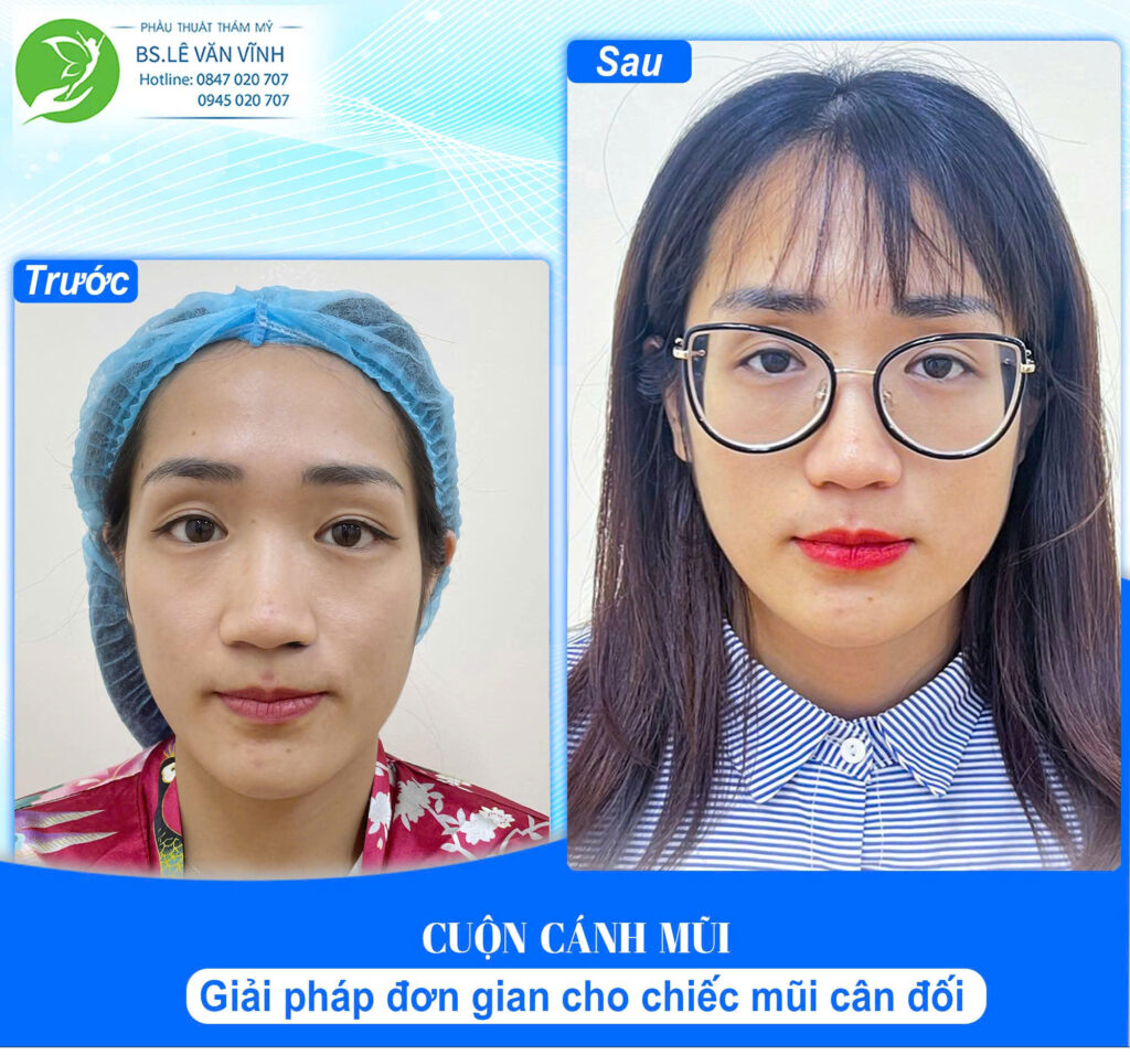 Cuộn cánh mũi do Bác sĩ Lê Văn Vĩnh thực hiện