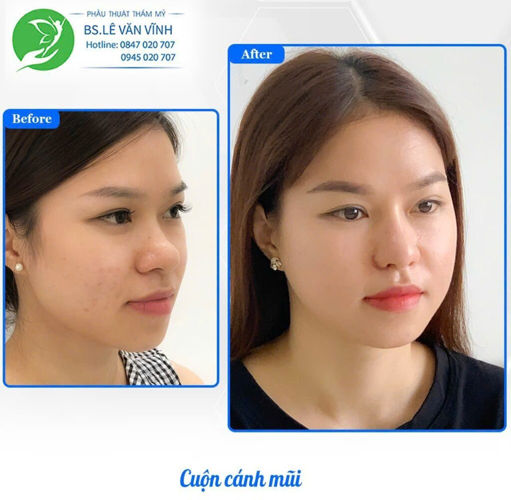 Cuộn cánh mũi do Bác sĩ Lê Văn Vĩnh thực hiện
