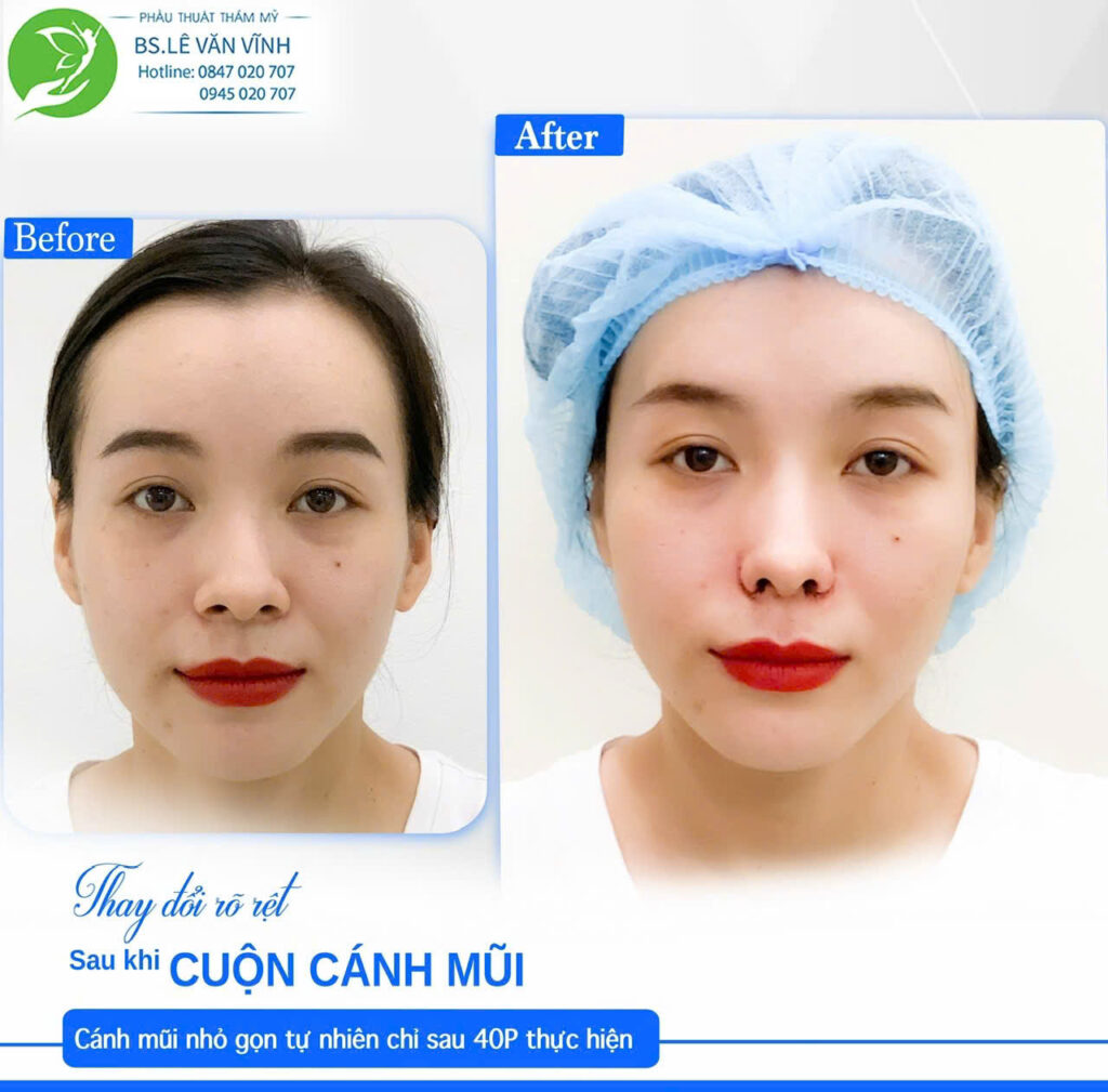 Cuộn cánh mũi do Bác sĩ Lê Văn Vĩnh thực hiện