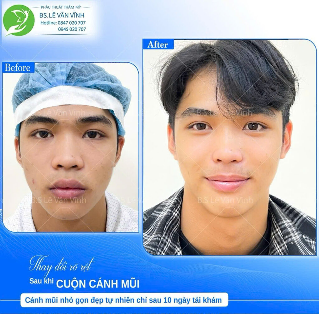 Cuộn cánh mũi do Bác sĩ Lê Văn Vĩnh thực hiện