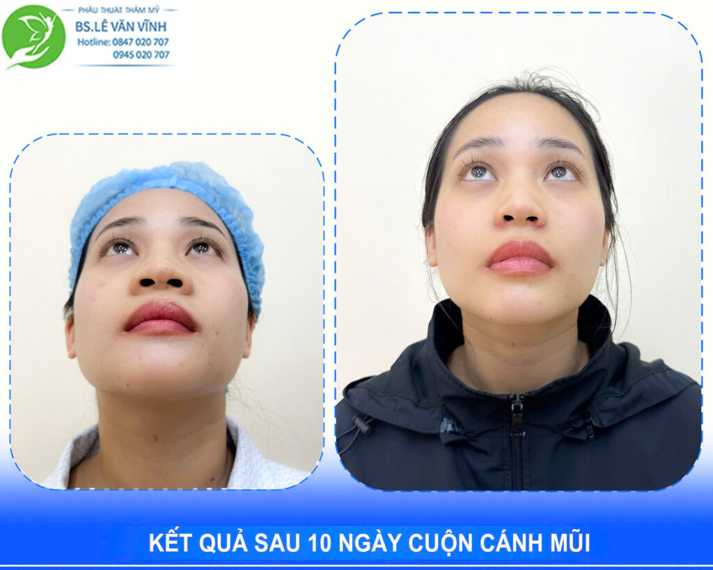Cuộn cánh mũi do Bác sĩ Lê Văn Vĩnh thực hiện
