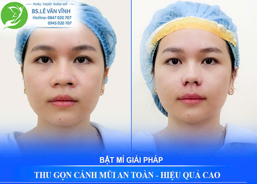 Thu gọn cánh mũi do Bác sĩ Lê Văn Vĩnh thực hiện