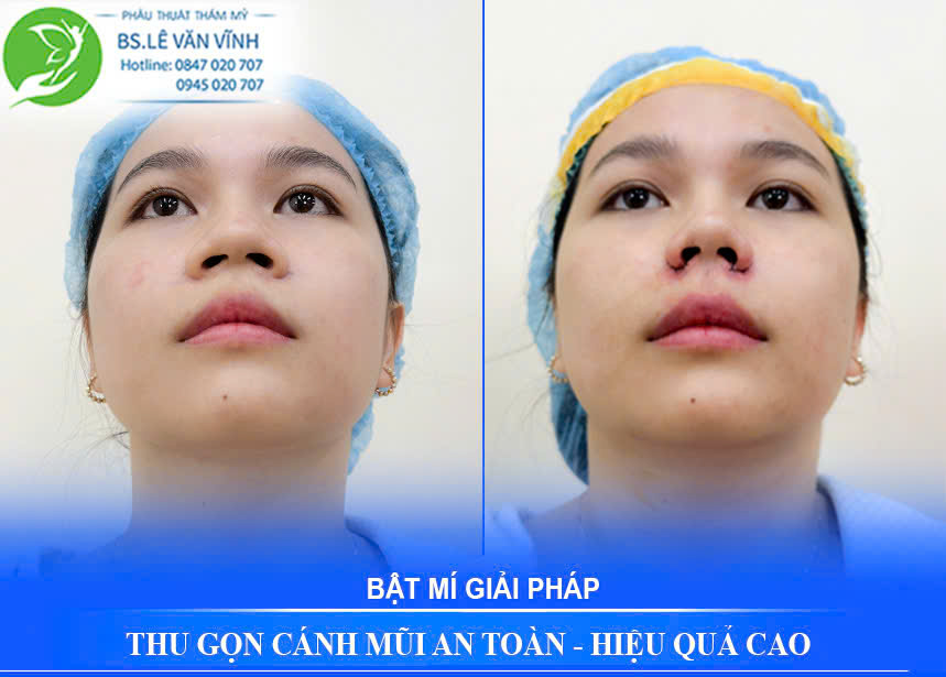 Thu gọn cánh mũi do Bác sĩ Lê Văn Vĩnh thực hiện