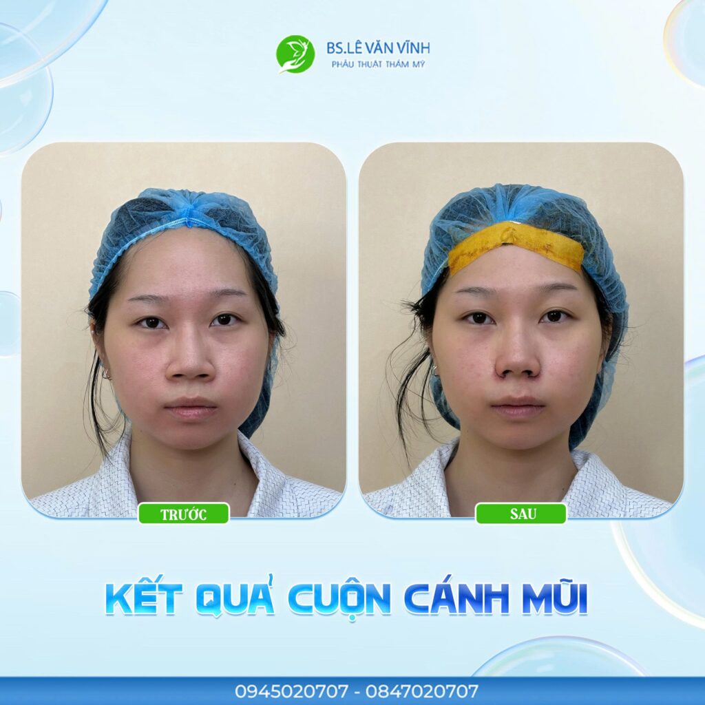 Cuộn cánh mũi do Bác sĩ Lê Văn Vĩnh thực hiện