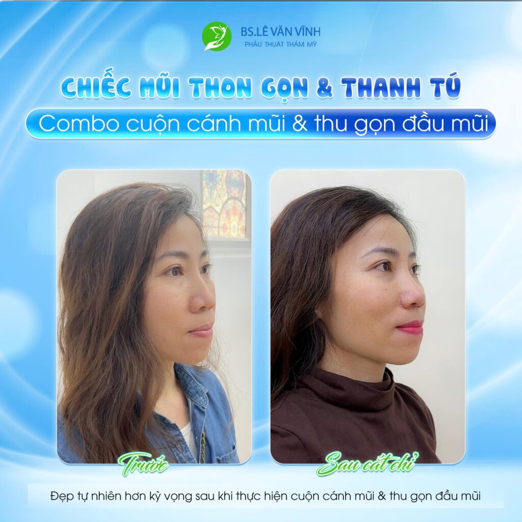 Cuộn cánh mũi & thu gọn đầu mũi do Bác sĩ Lê Văn Vĩnh thực hiện