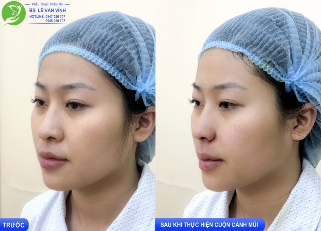 Cuộn cánh mũi do Bác sĩ Lê Văn Vĩnh thực hiện