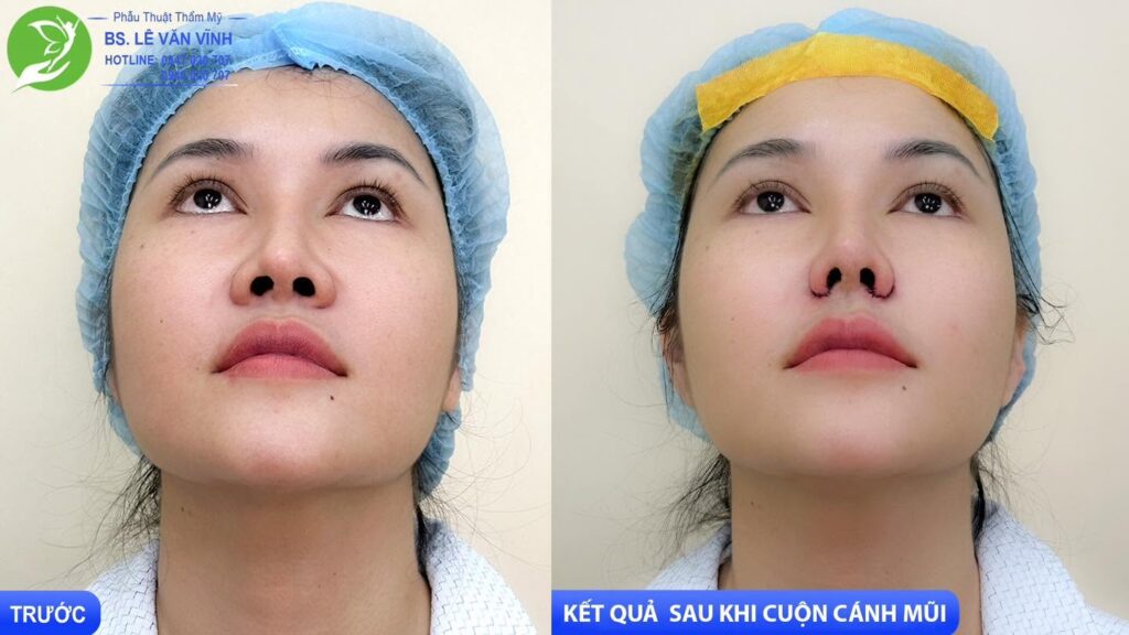 Cuộn cánh mũi do Bác sĩ Lê Văn Vĩnh thực hiện