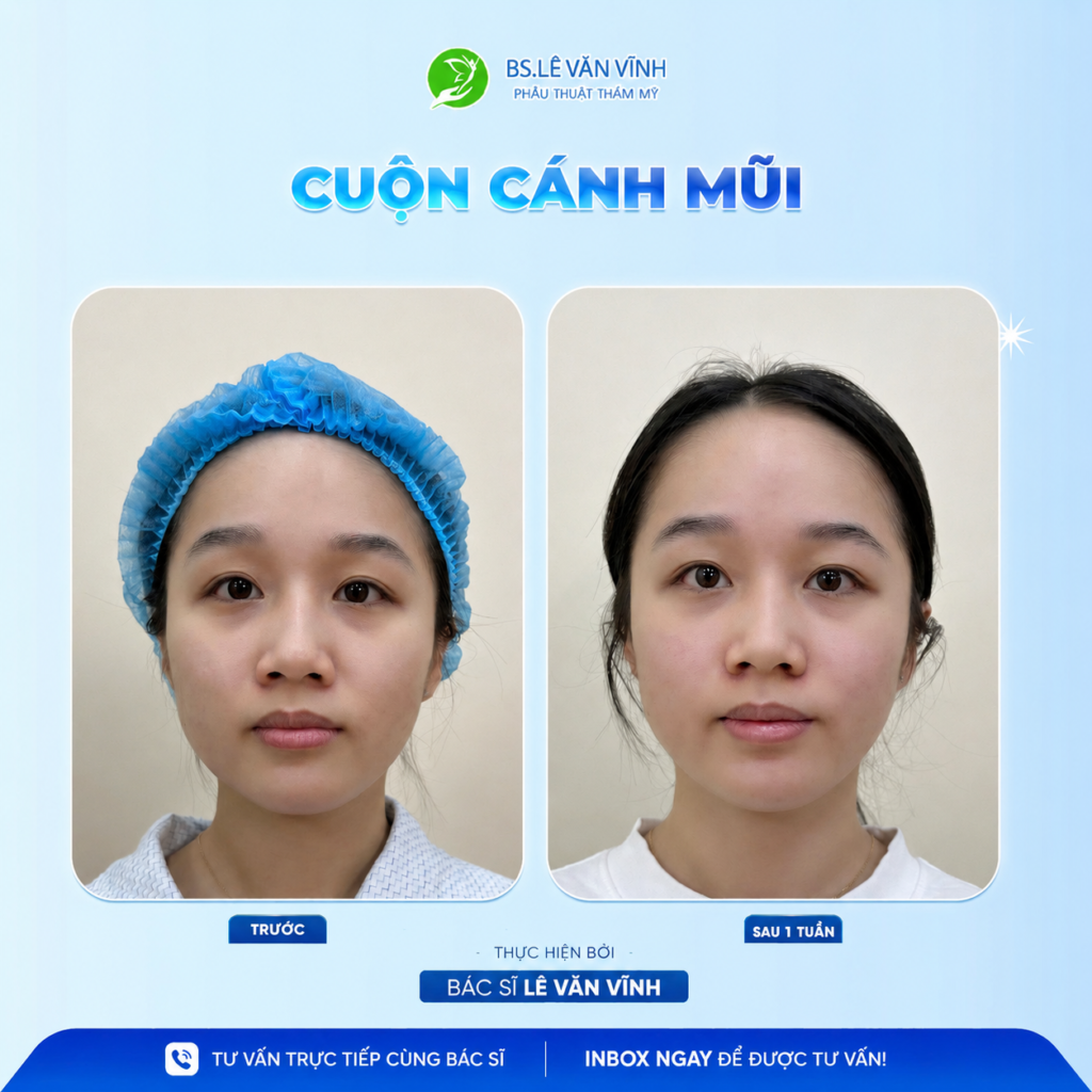 Cuộn cánh mũi do Bác sĩ Lê Văn Vĩnh thực hiện
