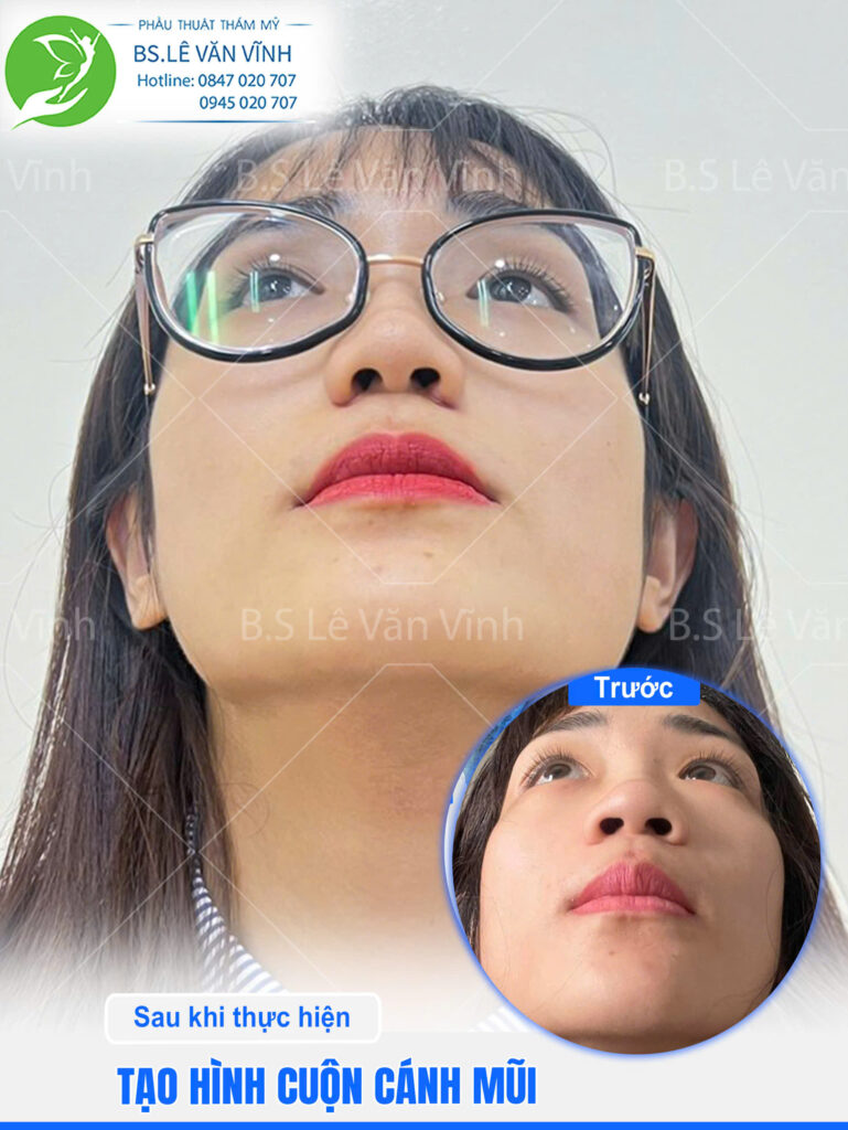 Cuộn cánh mũi do Bác sĩ Lê Văn Vĩnh thực hiện