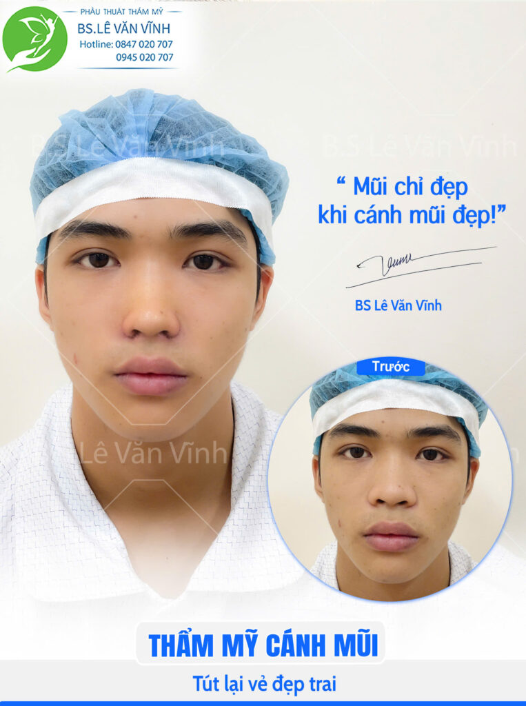Cuộn cánh mũi do Bác sĩ Lê Văn Vĩnh thực hiện