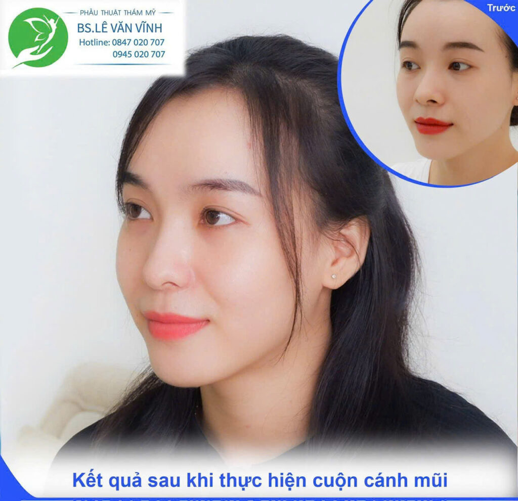 Cuộn cánh mũi do Bác sĩ Lê Văn Vĩnh thực hiện