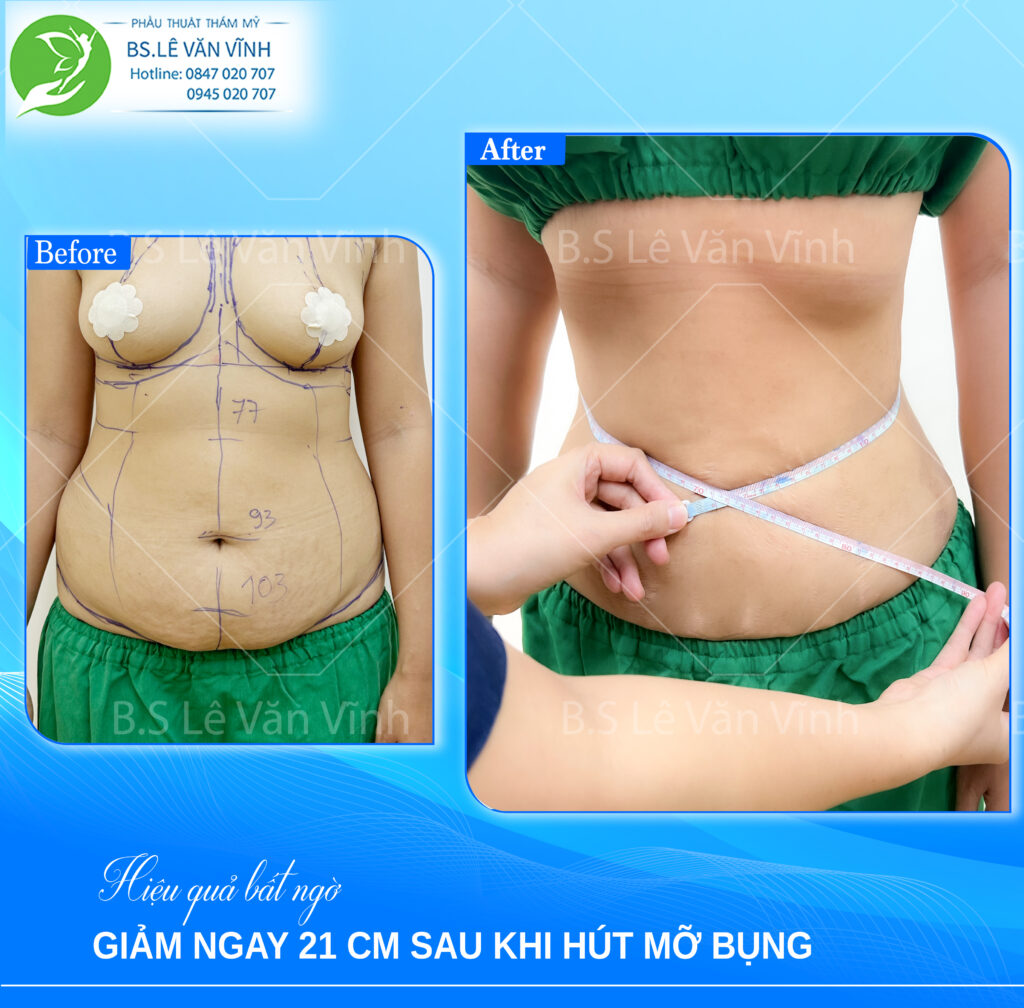 Kết quả hút mỡ bụng- về dáng nhanh hơn trên cùng một lộ trình