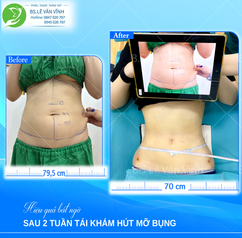 Kết quả hút mỡ bụng- về dáng nhanh hơn trên cùng một lộ trình