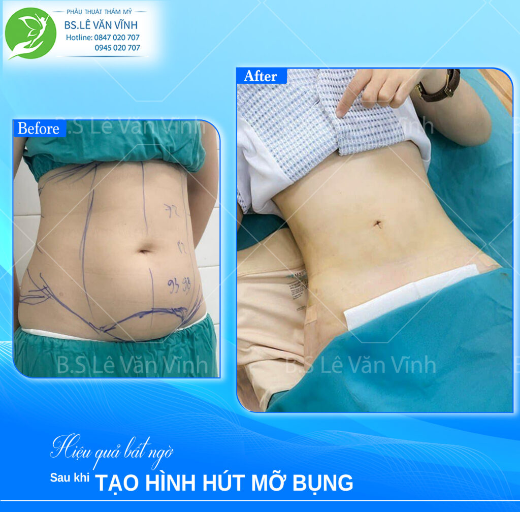 Kết quả hút mỡ bụng- về dáng nhanh hơn trên cùng một lộ trình