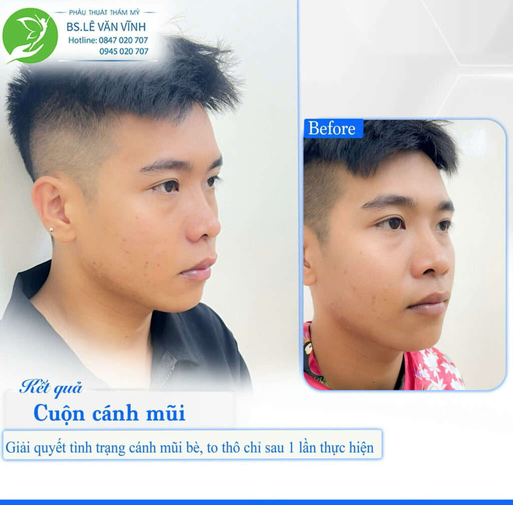 Cuộn cánh mũi do Bác sĩ Lê Văn Vĩnh thực hiện