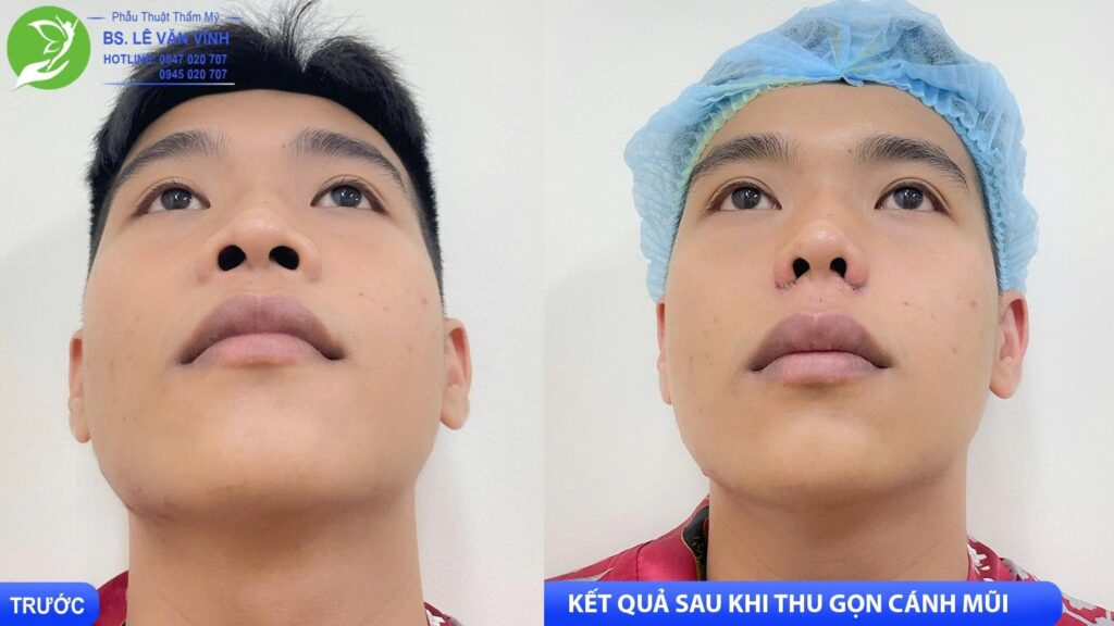 Thu gọn cánh mũi do Bác sĩ Lê Văn Vĩnh thực hiện