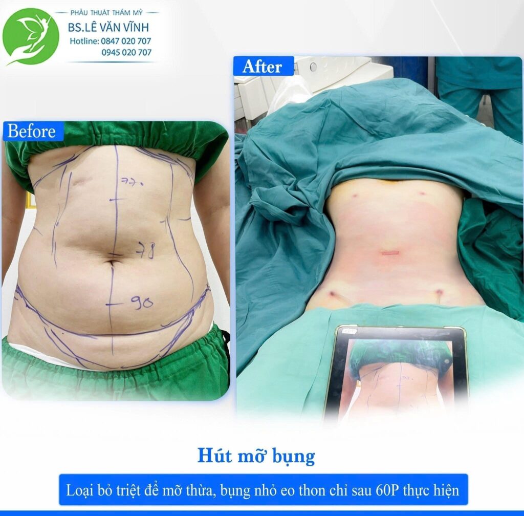 Kết quả hút mỡ bụng. Về dáng nhanh hơn trên cùng một lộ trình