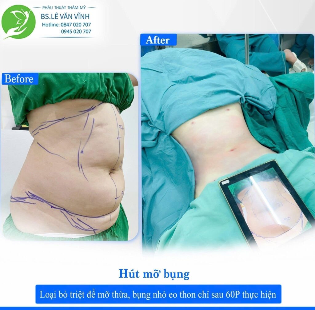 Kết quả hút mỡ bụng. Về dáng nhanh hơn trên cùng một lộ trình