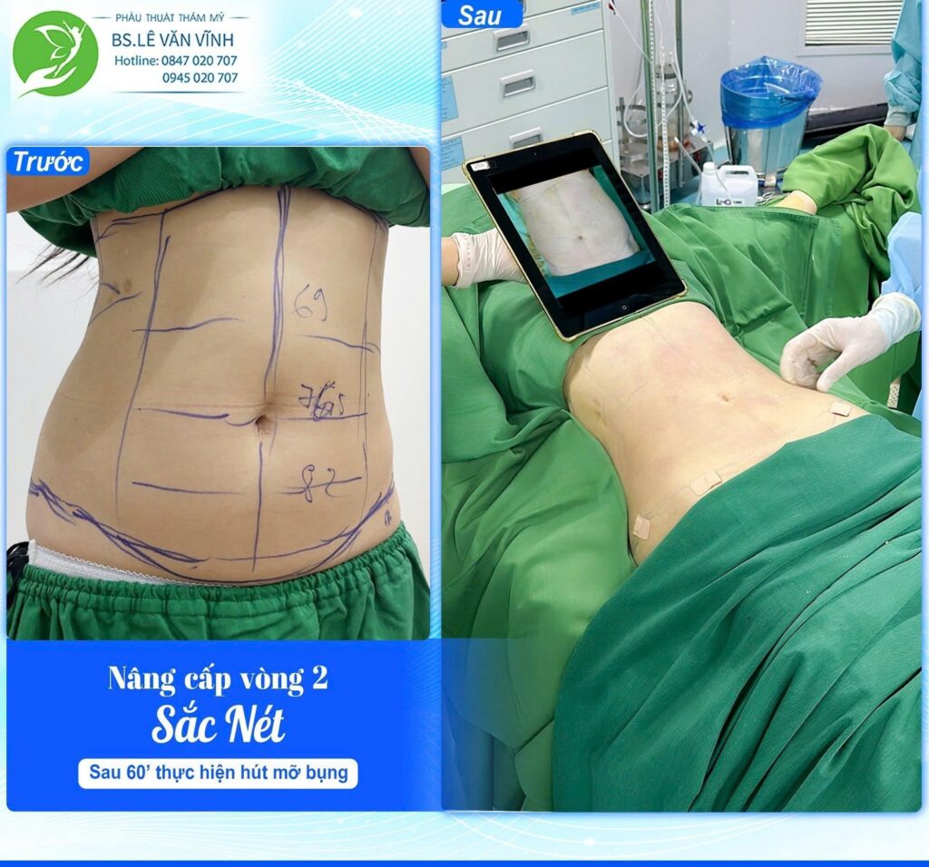 Kết quả hút mỡ bụng. Về dáng nhanh hơn trên cùng một lộ trình