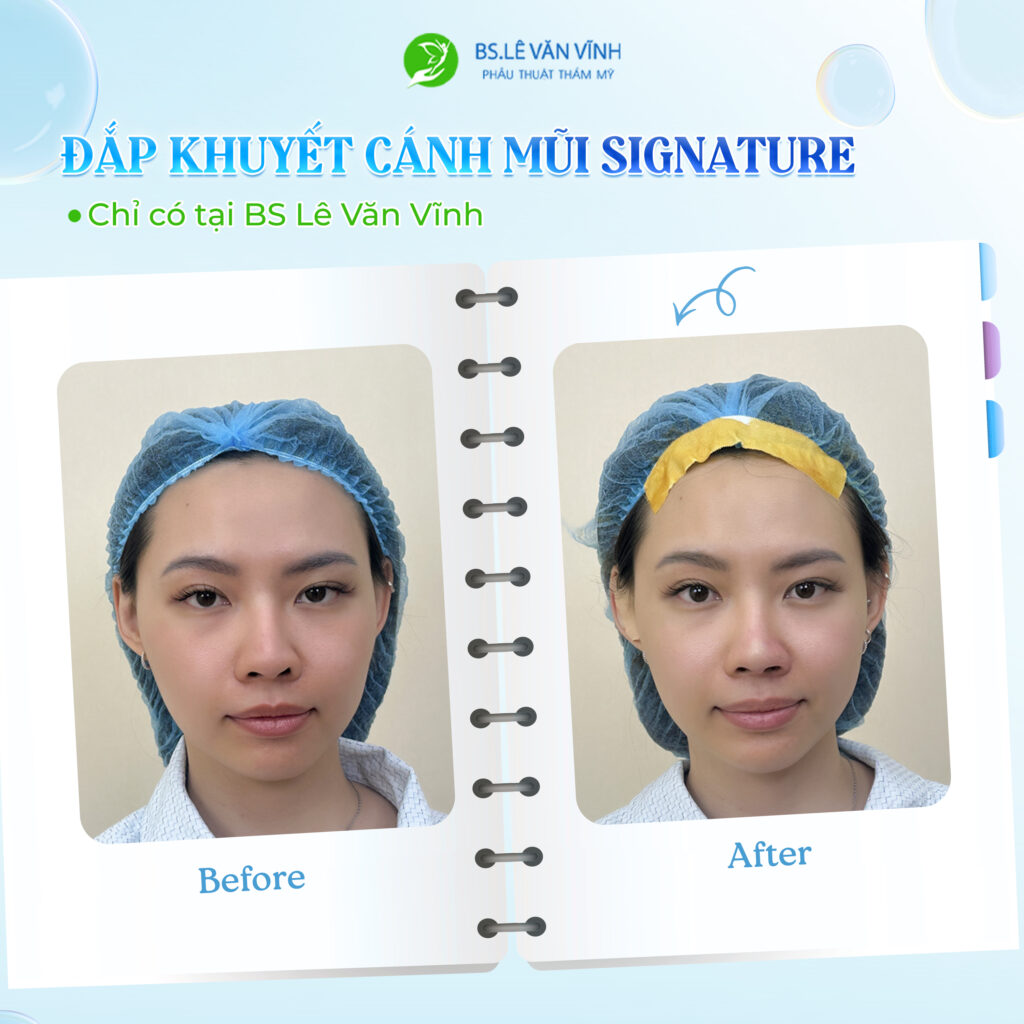 Đắp khuyết cánh mũi do Bác sĩ Lê Văn Vĩnh thực hiện