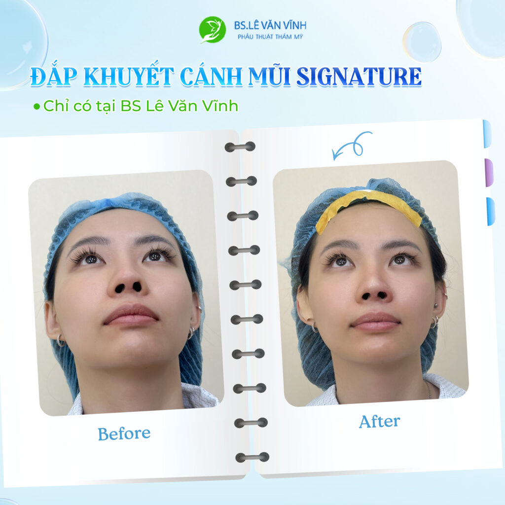 Đắp khuyết cánh mũi do Bác sĩ Lê Văn Vĩnh thực hiện