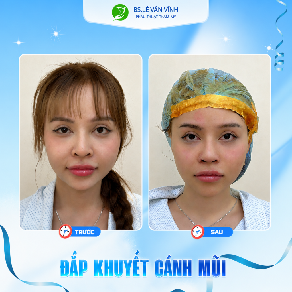 Đắp khuyết cánh mũi do Bác sĩ Lê Văn Vĩnh thực hiện