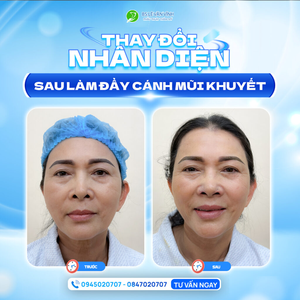 Đắp khuyết cánh mũi do Bác sĩ Lê Văn Vĩnh thực hiện