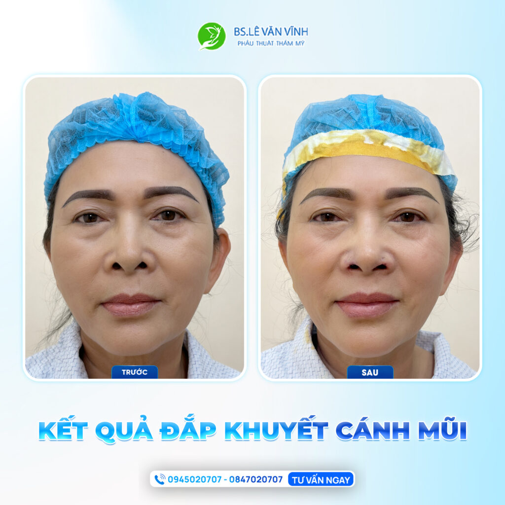 Đắp khuyết cánh mũi do Bác sĩ Lê Văn Vĩnh thực hiện