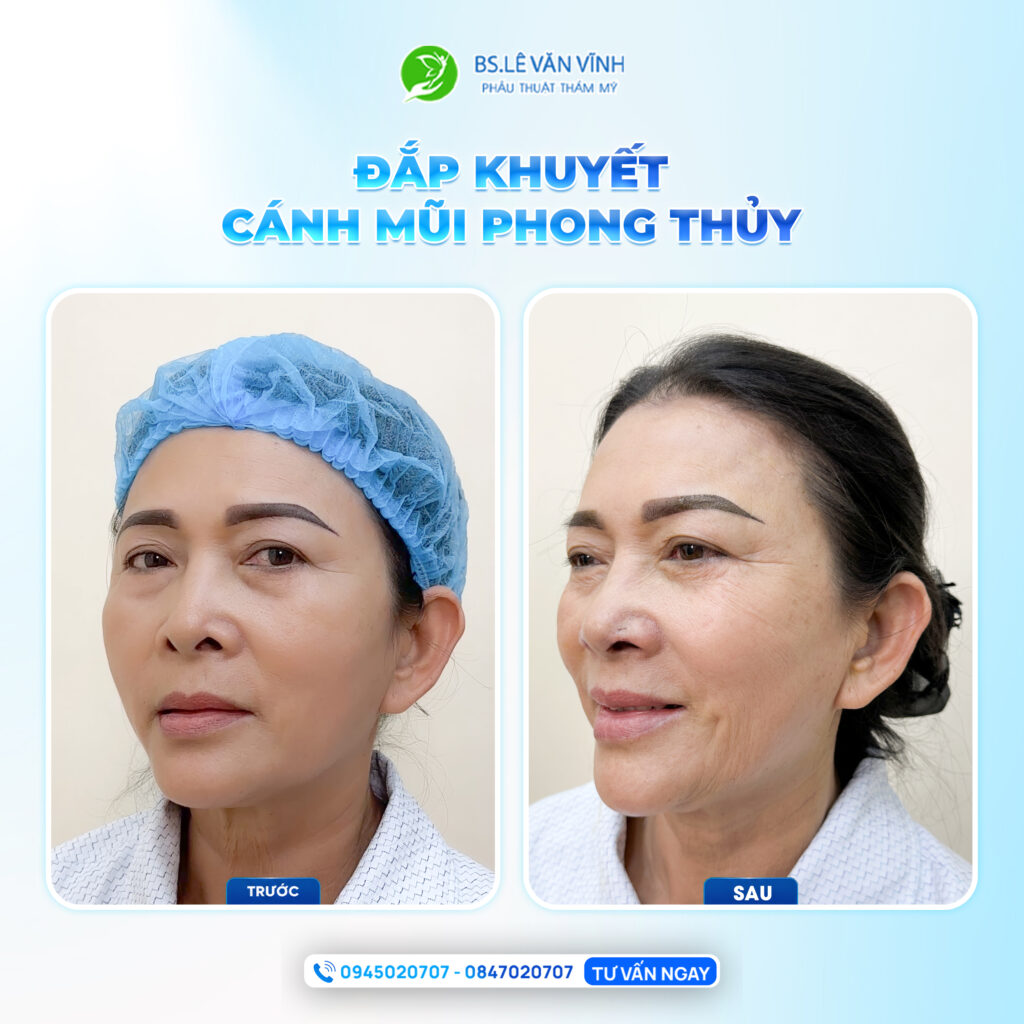 Đắp khuyết cánh mũi do Bác sĩ Lê Văn Vĩnh thực hiện