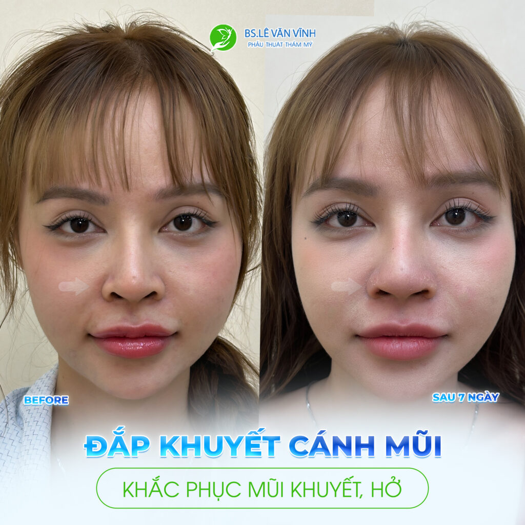 Đắp khuyết cánh mũi do Bác sĩ Lê Văn Vĩnh thực hiện