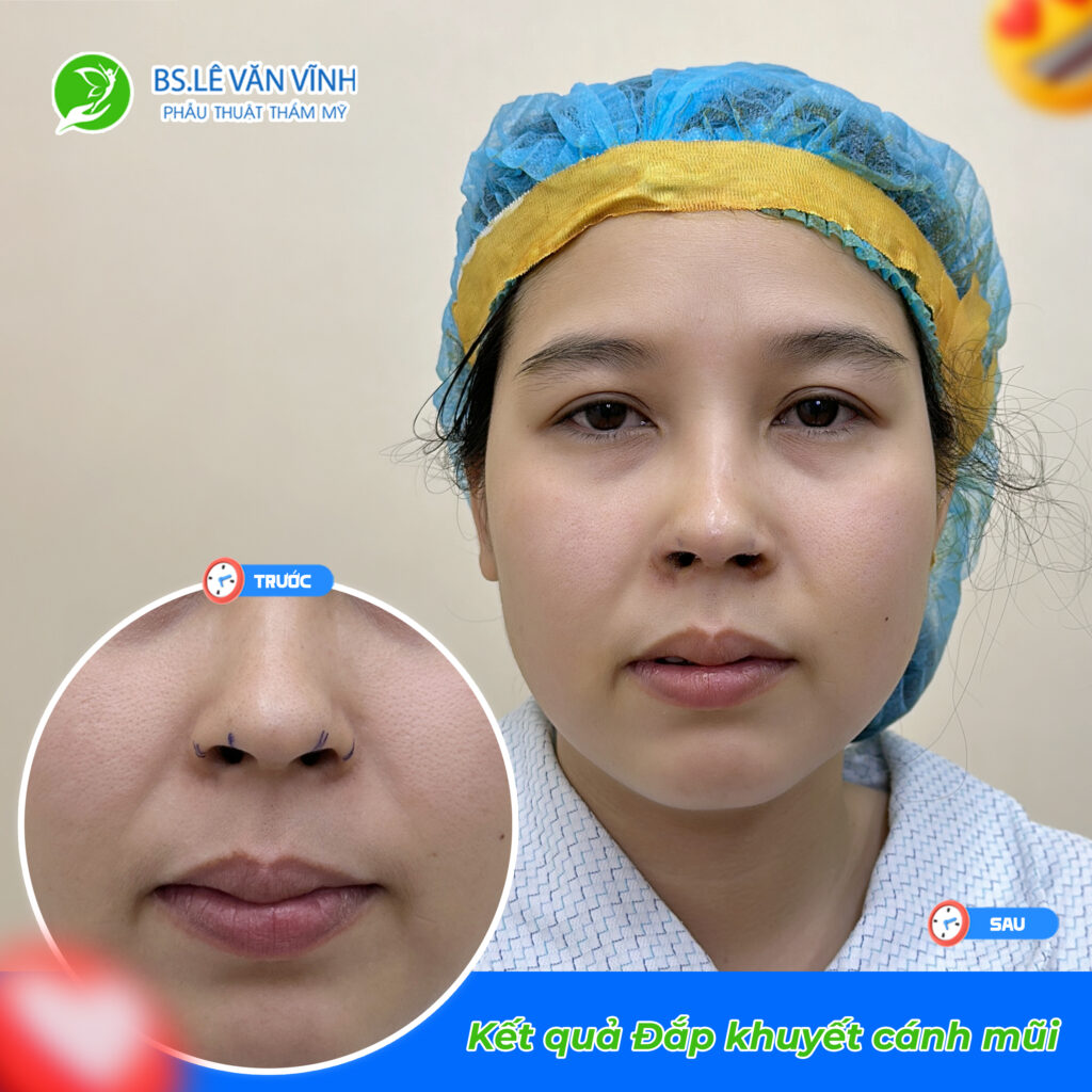 Đắp khuyết cánh mũi do Bác sĩ Lê Văn Vĩnh thực hiện