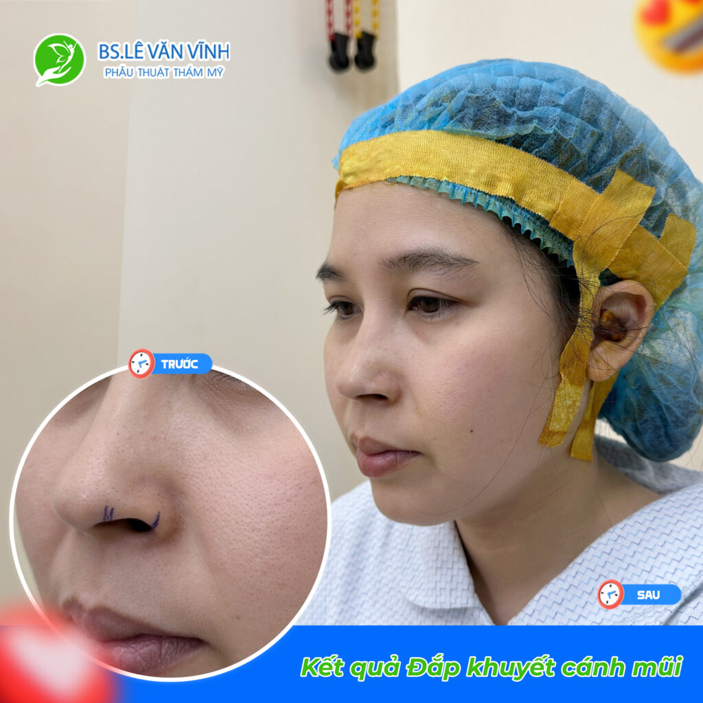 Đắp khuyết cánh mũi do Bác sĩ Lê Văn Vĩnh thực hiện