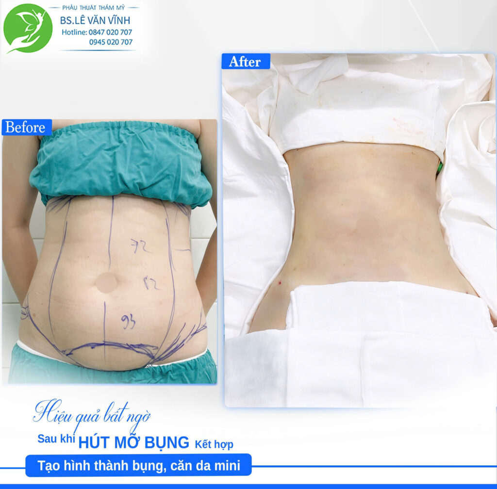 Kết quả hút mỡ bụng, căng da mini. Về dáng nhanh hơn trên cùng một lộ trình